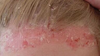 garapenaren faseak eta psoriasiaren sintomak