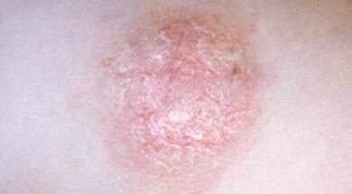 nola aitortu psoriasia hasiera batean