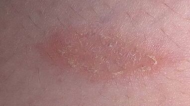 nola eta zerekin tratatu psoriasia