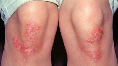 psoriasiaren adierazpen nagusiak
