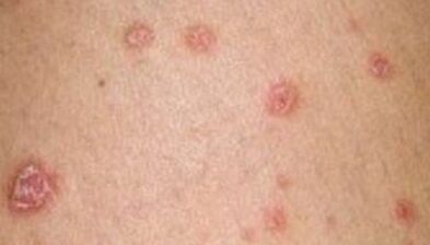psoriasiaren argazkia hasierako fasean