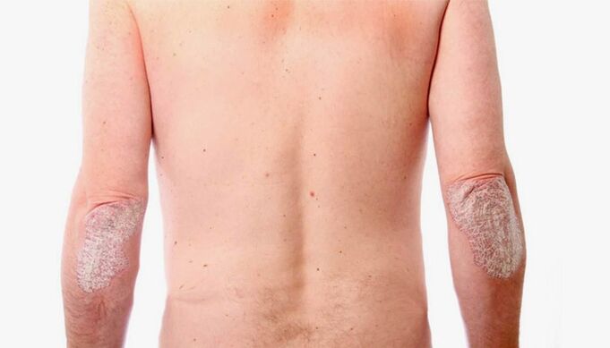 psoriasia tratatzeko folk erremedioak