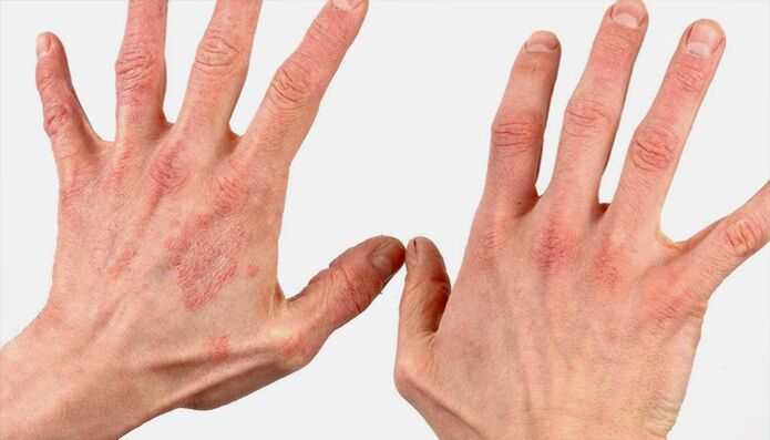 psoriasia tratatzeko metodo folk erremedioekin