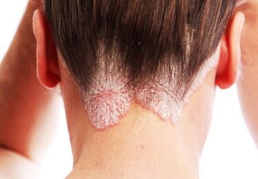 Psoriasia buruan