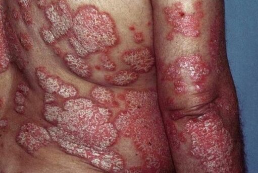 Psoriasia
