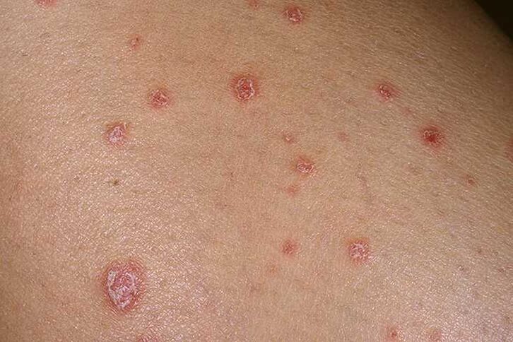 Psoriasiaren kausak