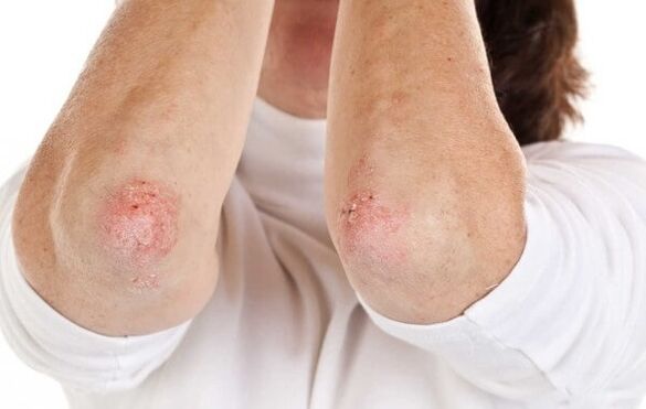 psoriasia