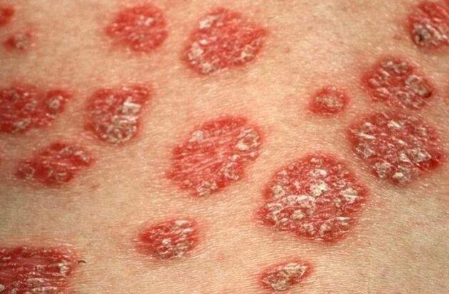 Papuletako psoriatikoak