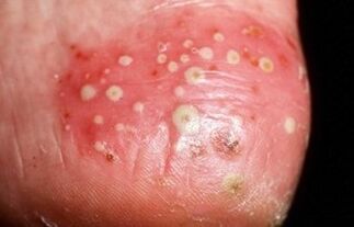 Psoriasia pustularra da