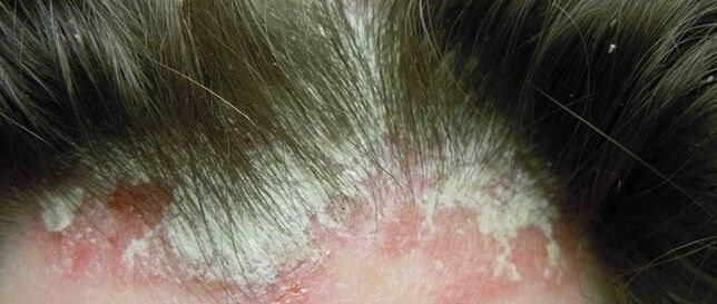 Psoriasia buruan