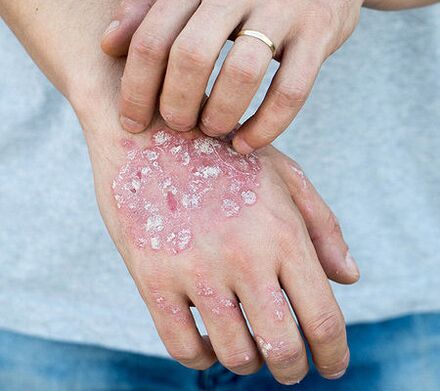 Psoriasia besoan