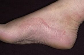 Oinaren psoriasia