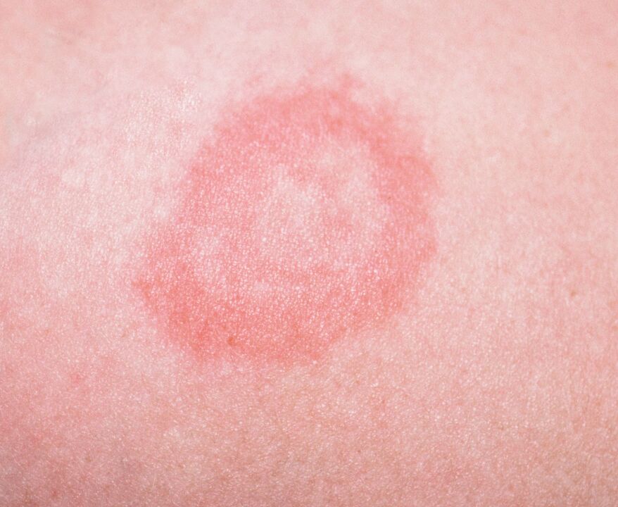 Psoriasia da