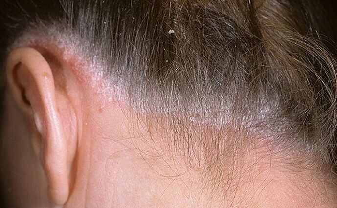 Psoriasia ilean