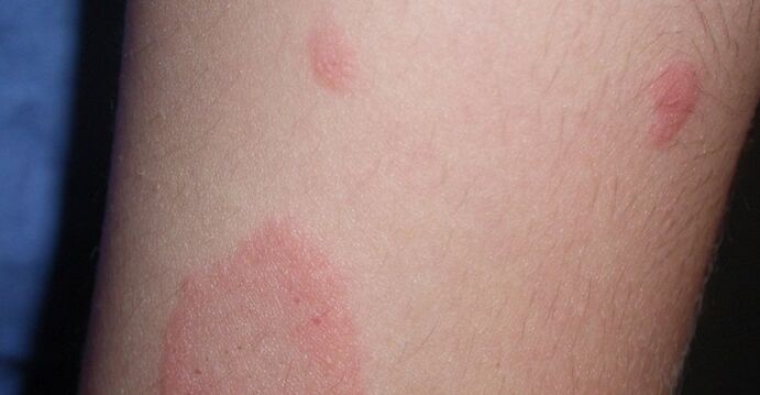 psoriasia