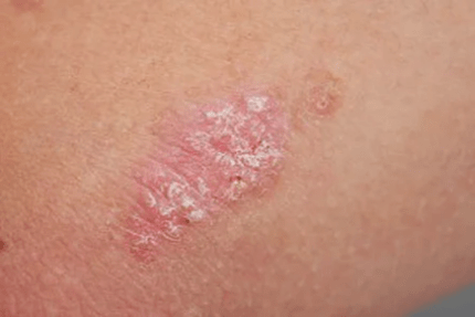Psoriasia - Hasierako etapa