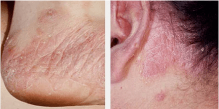 Psoriasia motak