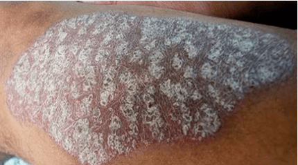 Psoriasia patogenesia