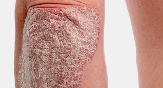 psoriasia