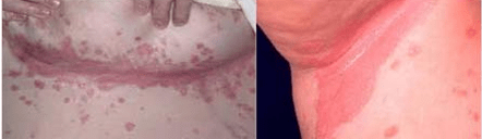 Psoriasia forma atipikoa