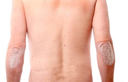 Psoriasiaren sintoma orokorrak