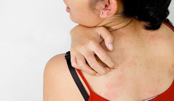 Psoriasia bizkarrean