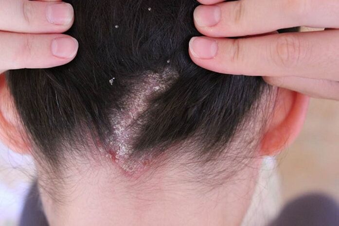 Psoriasia buruan