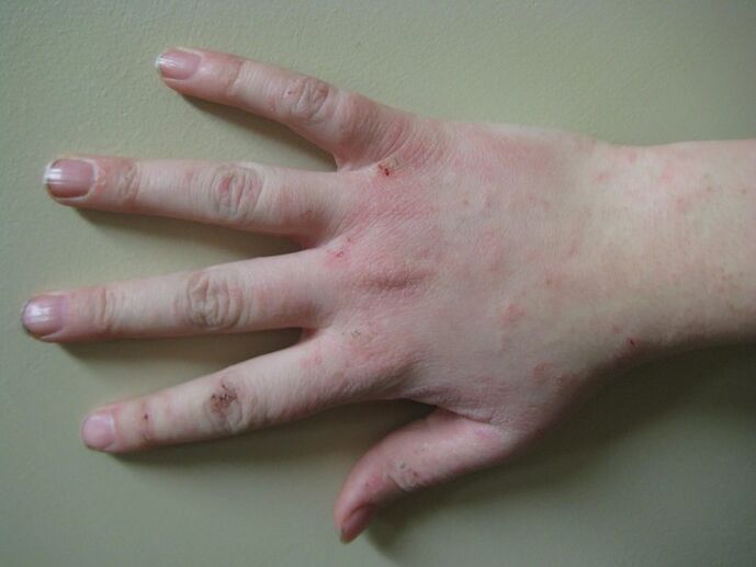 Psoriasia hasierako fasean