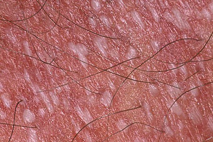 Psoriasia pustularra