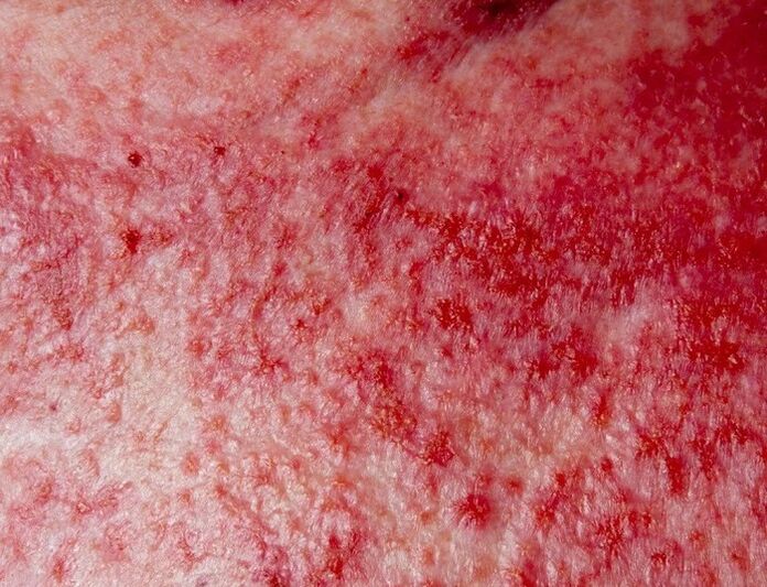 Psoriasiaren forma aurreratua