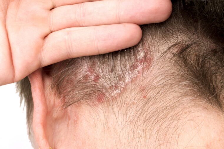 Buruko psoriasia areagotzea