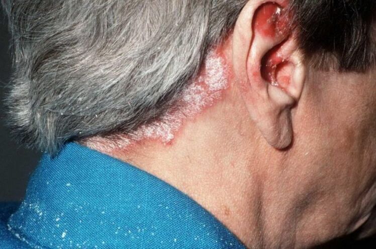 Psoriasia buruan