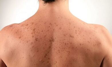 psoriasia garatzeko arrazoiak