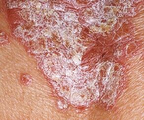 Psoriasiaren fase geldikoa