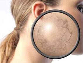 Nola agertzen da psoriasia