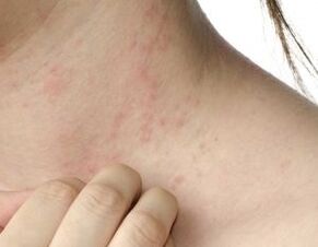 psoriasiaren sintoma nagusiak