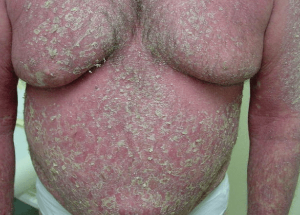 Eritrodermia psoriatikoa gorputzean