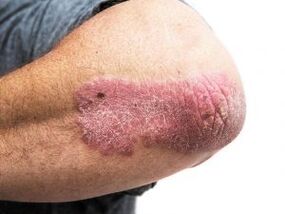 Plaka psoriasia ukondoan