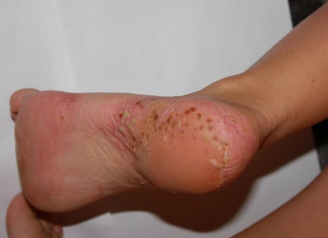 Psoriasia palmoplantarra