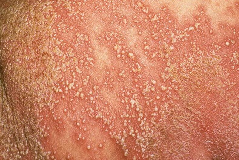 Psoriasia pustularra