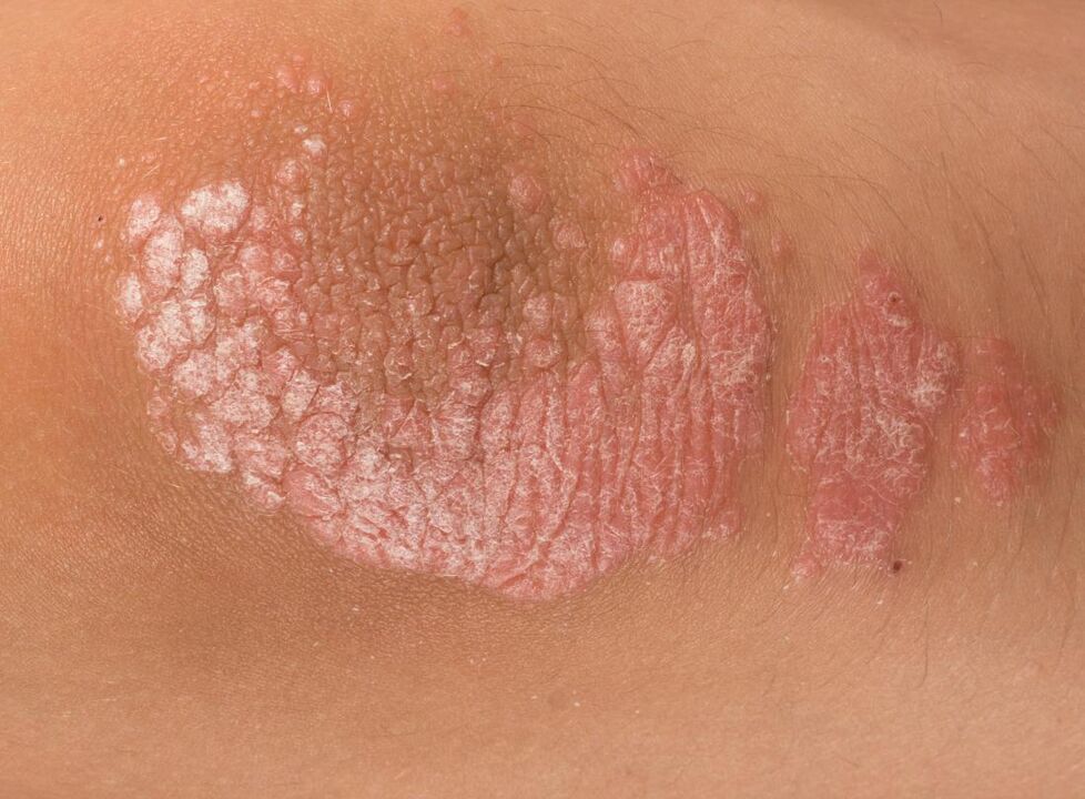 Psoriasia