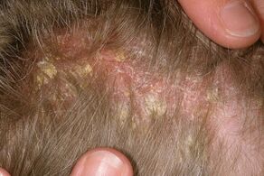 Psoriasia buruan