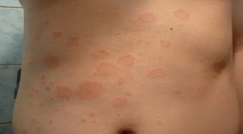 Psoriasia gorputzean