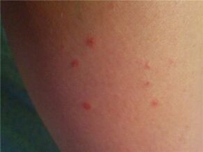 Psoriasia larruazalean