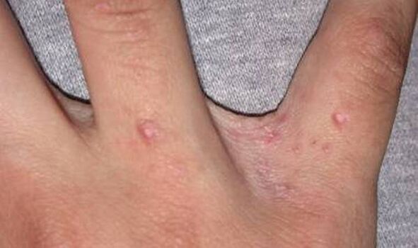Psoriasiaren hasiera